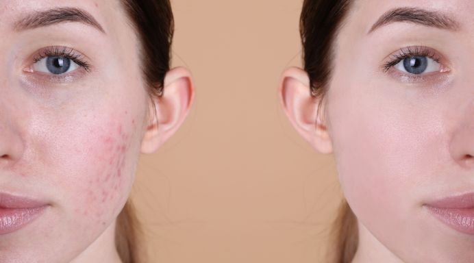 anti scar treatment in Ahmedabad
