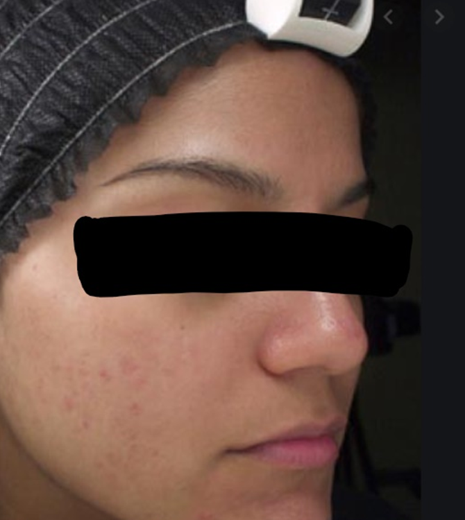 Chemical Peels After Treatment