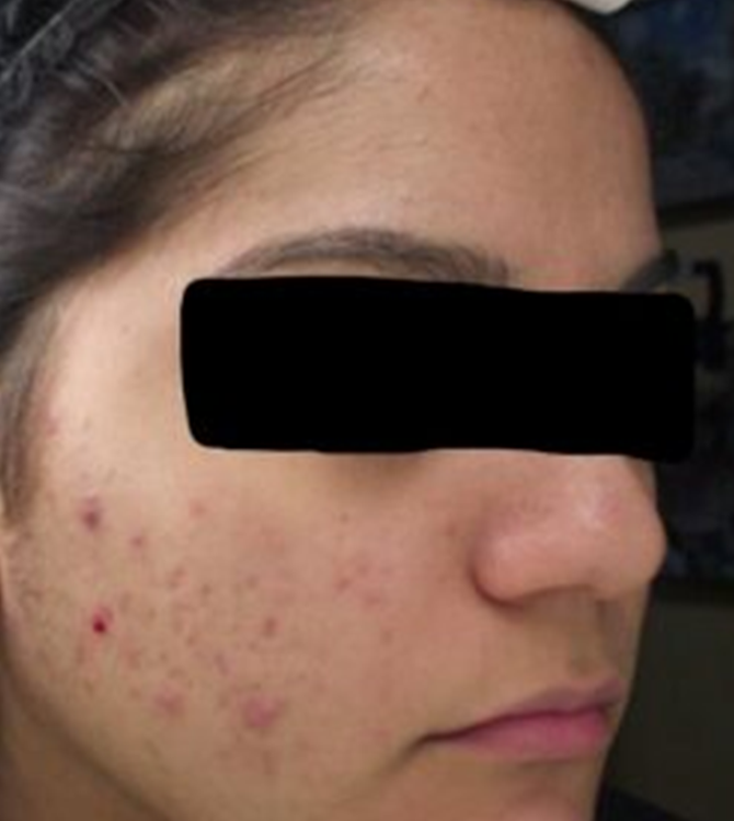 Chemical Peels Before Treatment