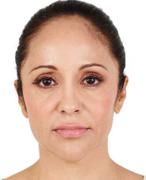 Anti Ageing Treatment in Ahmedabad