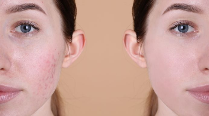 5 Reasons to Treat Acne Early