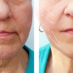 anti aging treatment