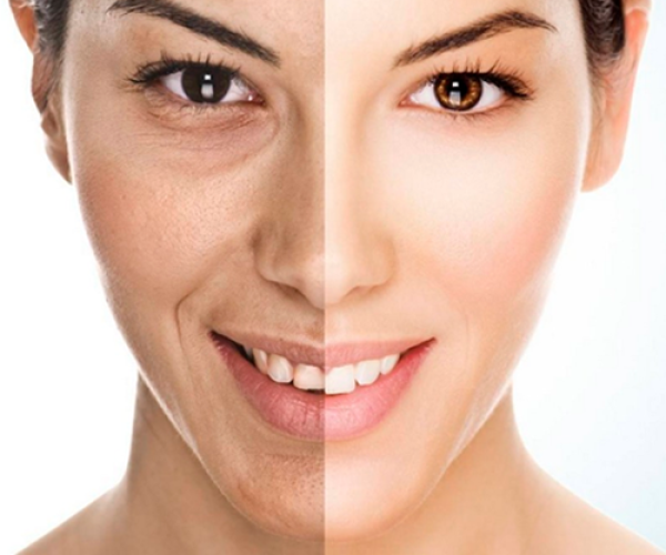 Laser for Pigmentation Before After